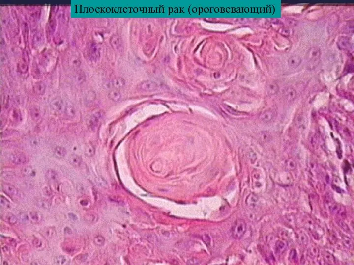 Плоскоклеточный рак (ороговевающий)