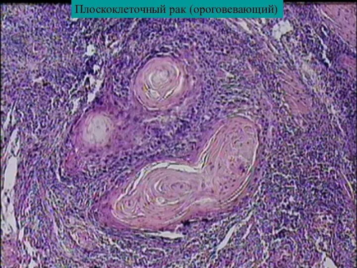 Плоскоклеточный рак (ороговевающий)