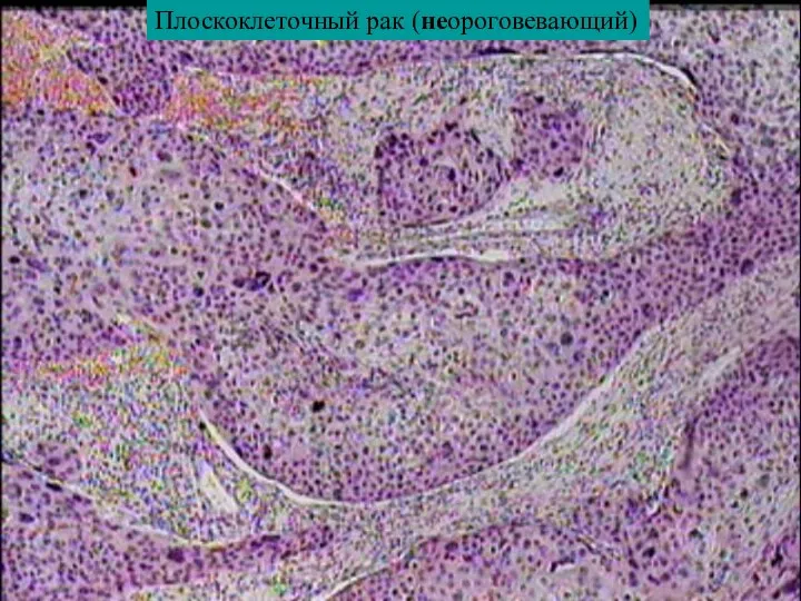 Плоскоклеточный рак (неороговевающий)