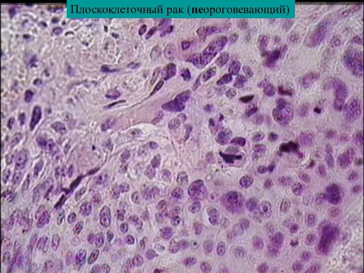 Плоскоклеточный рак (неороговевающий)