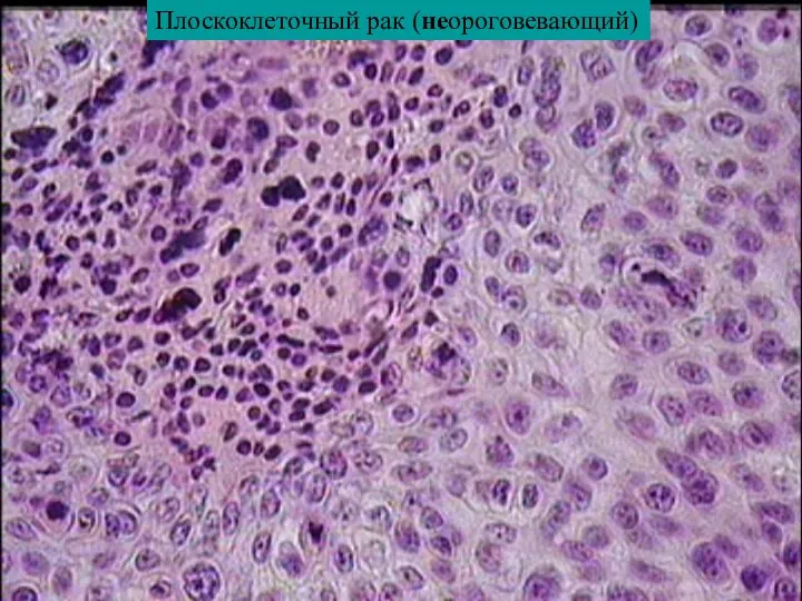 Плоскоклеточный рак (неороговевающий)