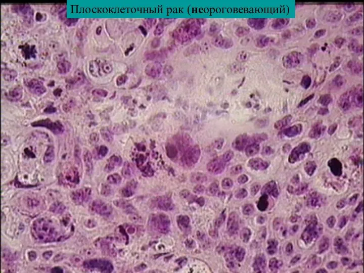 Плоскоклеточный рак (неороговевающий)