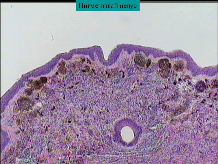 Пигментный невус