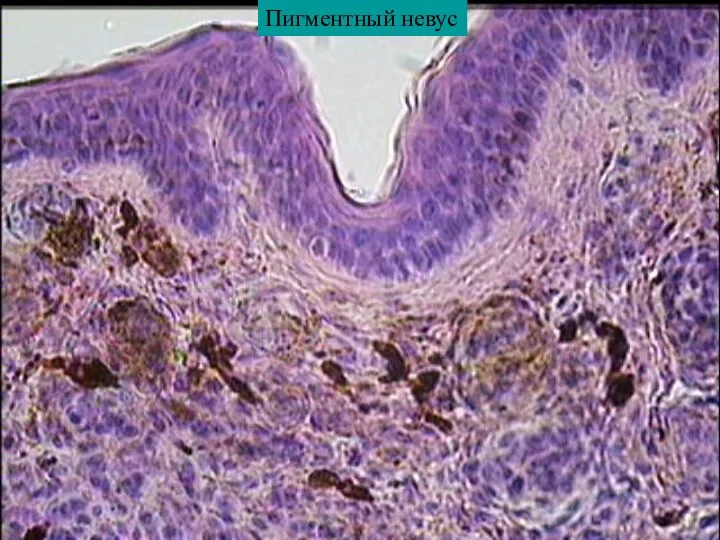 Пигментный невус