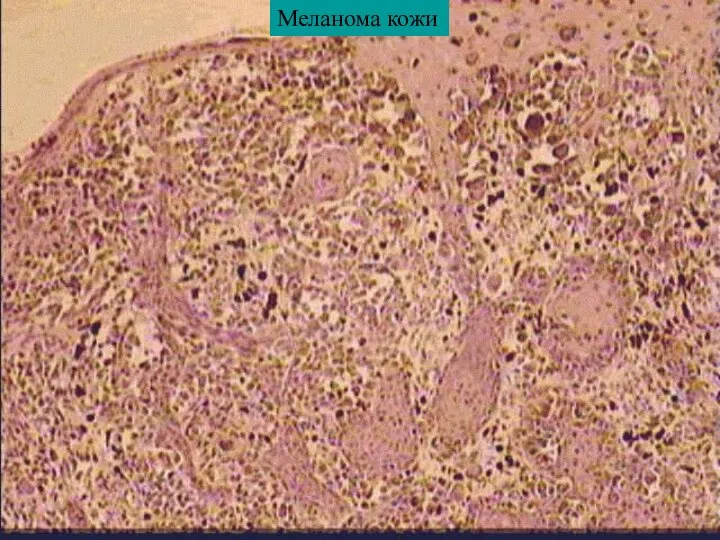 Меланома кожи