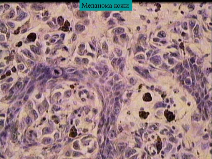 Меланома кожи
