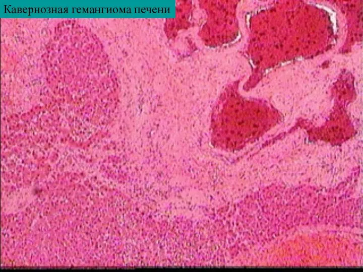 Кавернозная гемангиома печени