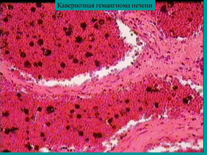 Кавернозная гемангиома печени