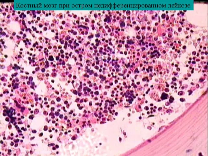 Костный мозг при остром недифференцированном лейкозе