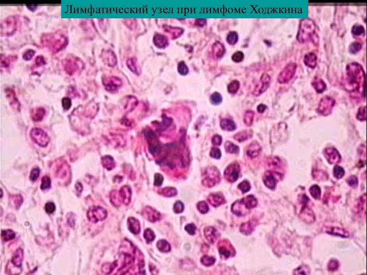 Лимфатический узел при лимфоме Ходжкина