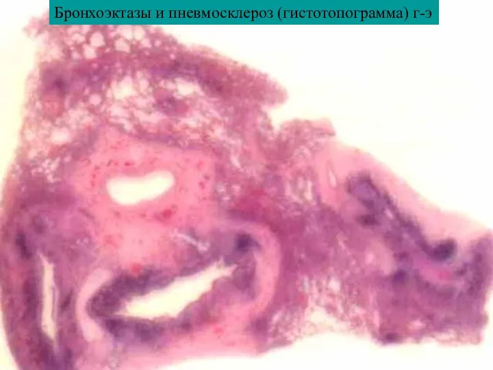 Бронхоэктазы и пневмосклероз (гистотопограмма) г-э