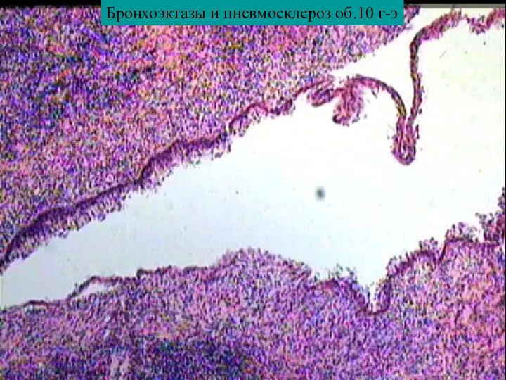 Бронхоэктазы и пневмосклероз об.10 г-э