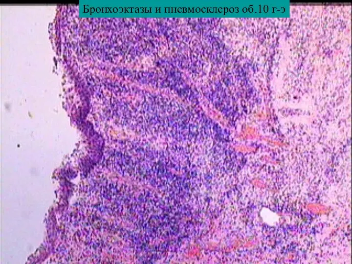 Бронхоэктазы и пневмосклероз об.10 г-э