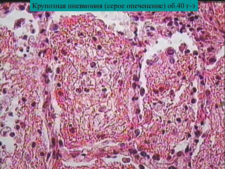 Крупозная пневмония (серое опеченение) об.40 г-э