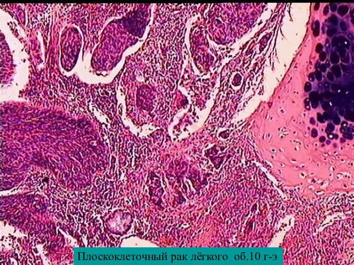 Плоскоклеточный рак лёгкого об.10 г-э