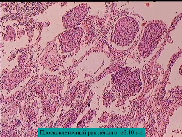Плоскоклеточный рак лёгкого об.10 г-э