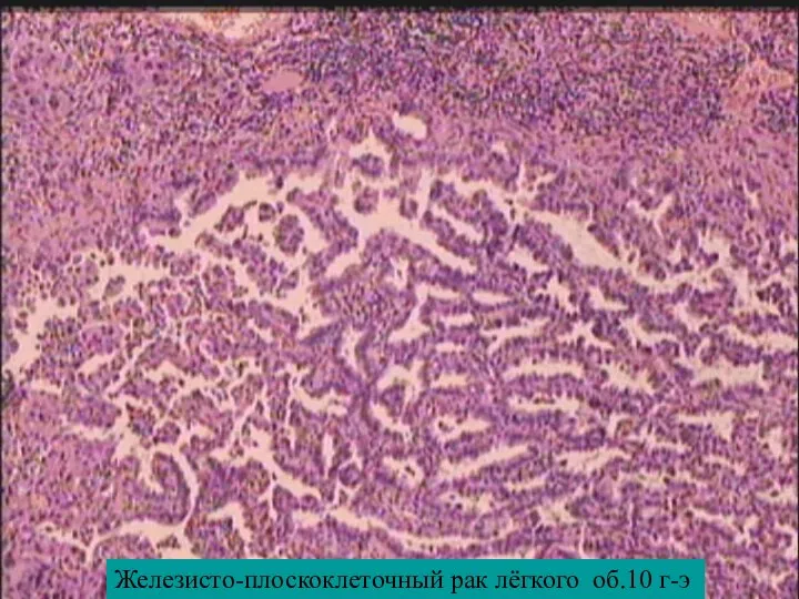 Железисто-плоскоклеточный рак лёгкого об.10 г-э