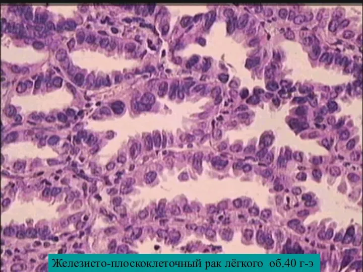 Железисто-плоскоклеточный рак лёгкого об.40 г-э