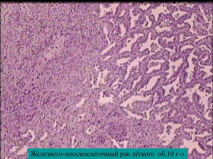 Железисто-плоскоклеточный рак лёгкого об.10 г-э