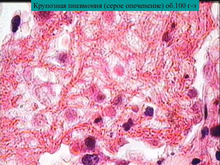 Крупозная пневмония (серое опеченение) об.100 г-э