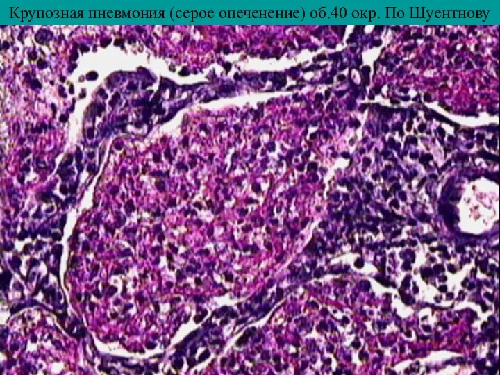Крупозная пневмония (серое опеченение) об.40 окр. По Шуентнову