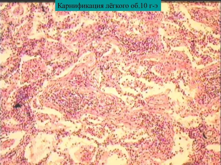 Карнификация лёгкого об.10 г-э