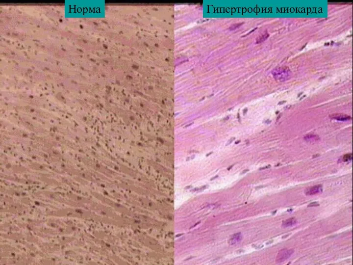 Гипертрофия миокарда Норма