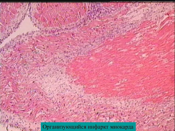 Организующийся инфаркт миокарда