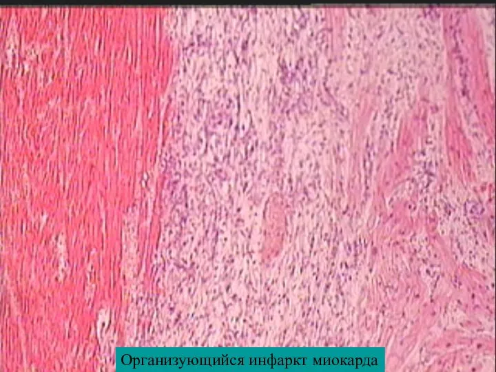 Организующийся инфаркт миокарда