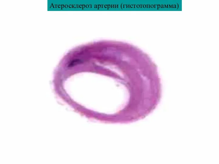Атеросклероз артерии (гистотопограмма)
