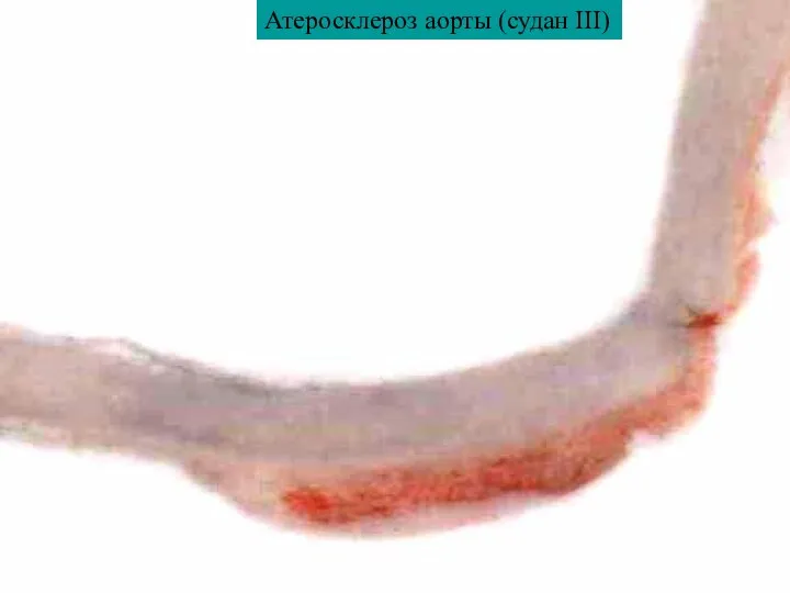 Атеросклероз аорты (судан III)