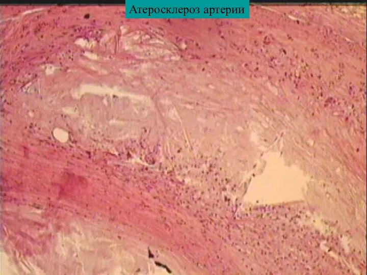 Атеросклероз артерии