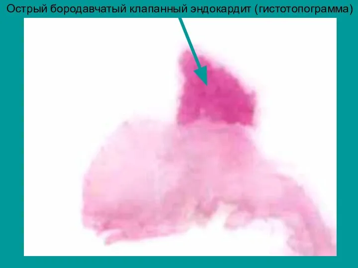 Острый бородавчатый клапанный эндокардит (гистотопограмма)