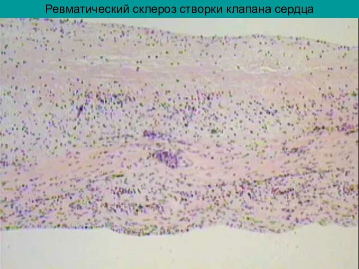 Ревматический склероз створки клапана сердца