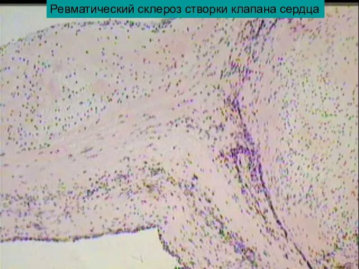 Ревматический склероз створки клапана сердца