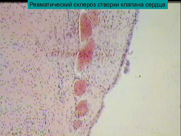 Ревматический склероз створки клапана сердца