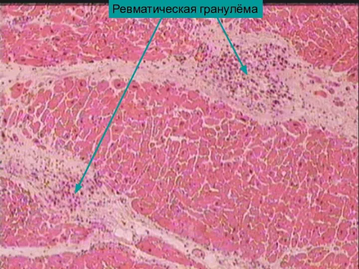 Ревматическая гранулёма