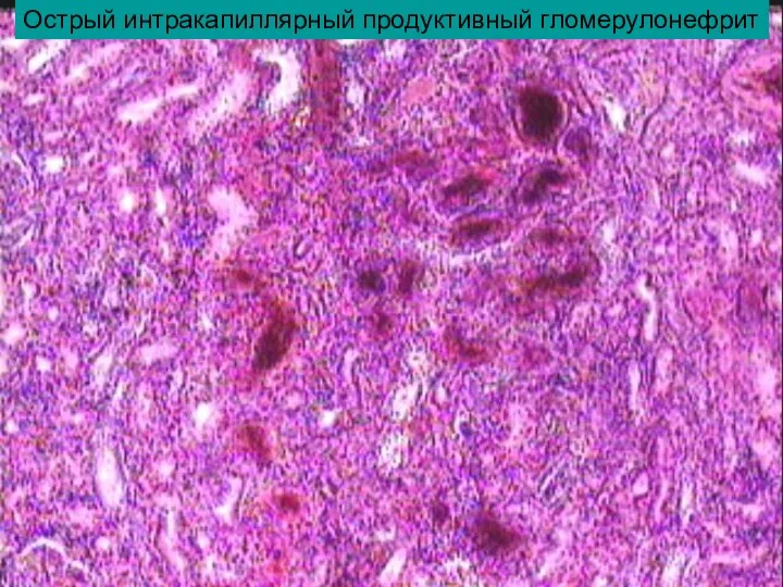 Острый интракапиллярный продуктивный гломерулонефрит