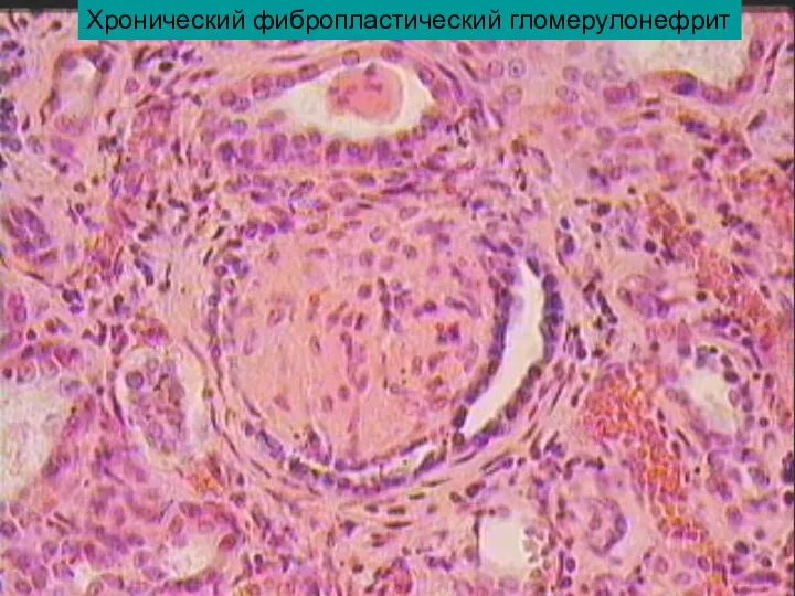 Хронический фибропластический гломерулонефрит