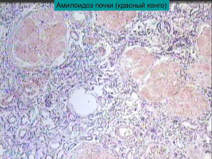 Амилоидоз почки (красный конго)