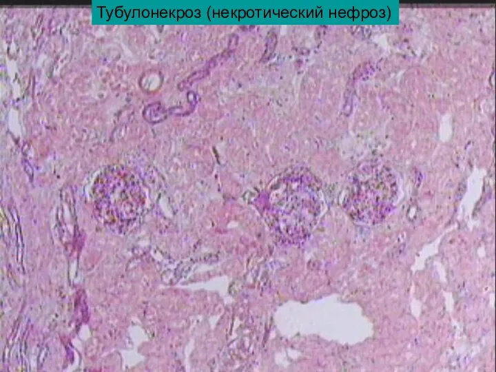 Тубулонекроз (некротический нефроз)