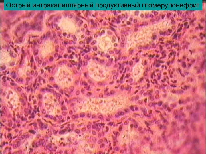 Острый интракапиллярный продуктивный гломерулонефрит