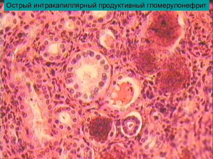 Острый интракапиллярный продуктивный гломерулонефрит
