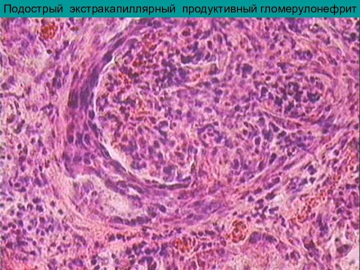 Подострый экстракапиллярный продуктивный гломерулонефрит