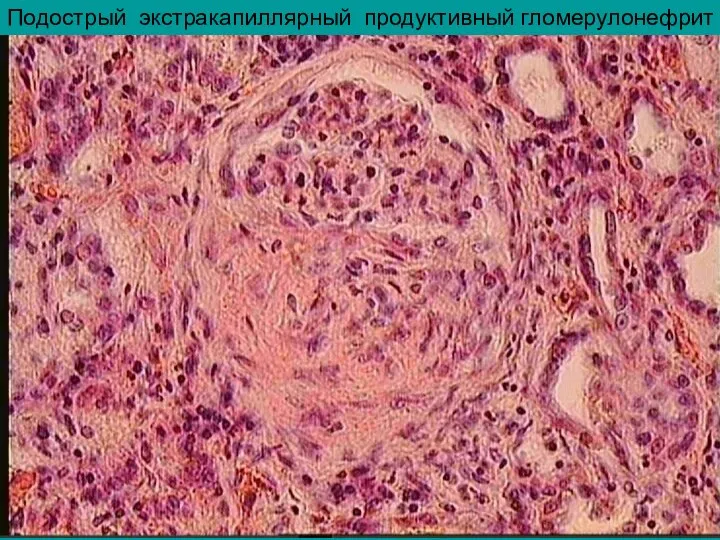 Подострый экстракапиллярный продуктивный гломерулонефрит