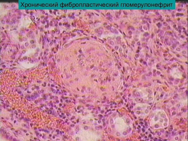 Хронический фибропластический гломерулонефрит
