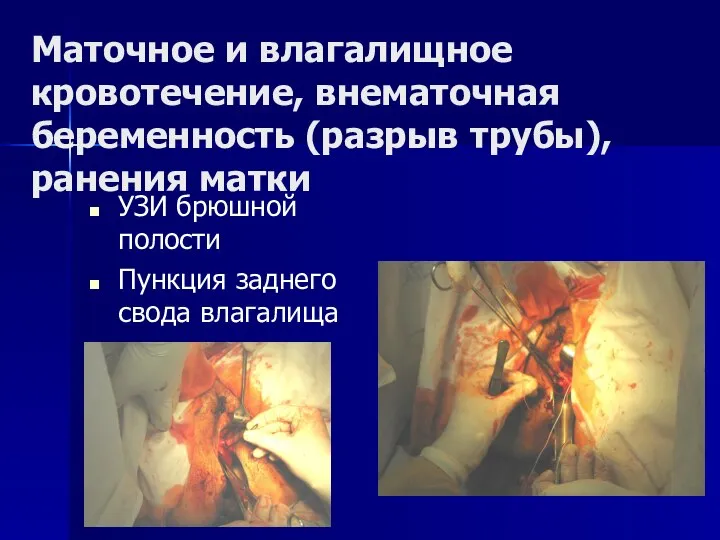 Маточное и влагалищное кровотечение, внематочная беременность (разрыв трубы), ранения матки УЗИ