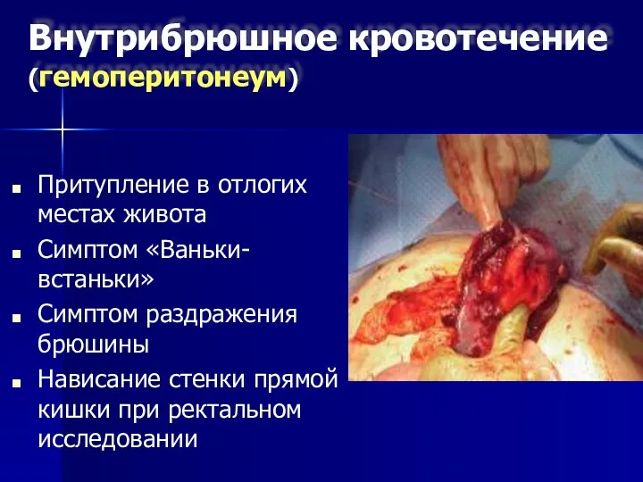 Внутрибрюшное кровотечение (гемоперитонеум) Притупление в отлогих местах живота Симптом «Ваньки-встаньки» Симптом