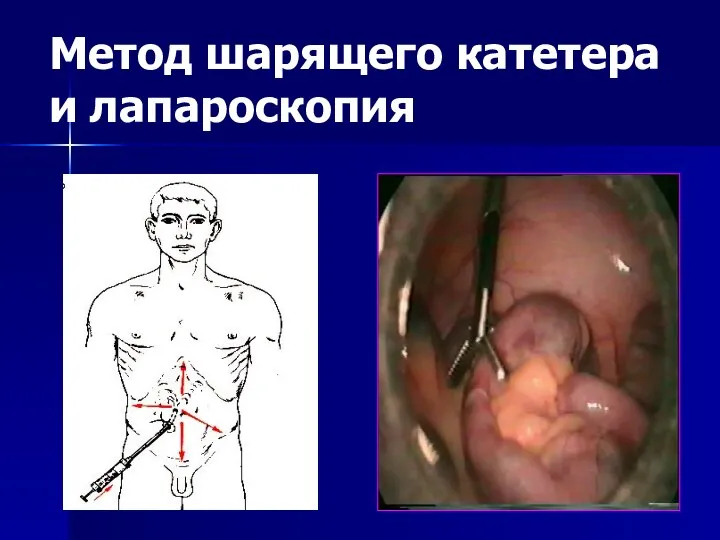 Метод шарящего катетера и лапароскопия