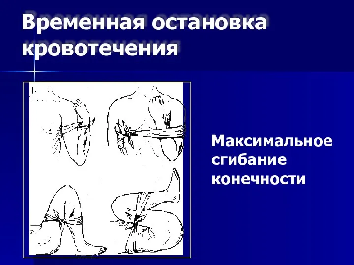 Временная остановка кровотечения Максимальное сгибание конечности